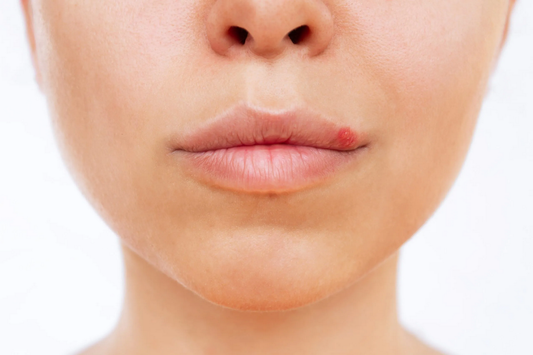 Woman with cold sore on lips caused by HSV-1. L-lysine use for herpes prevention and symptom management
