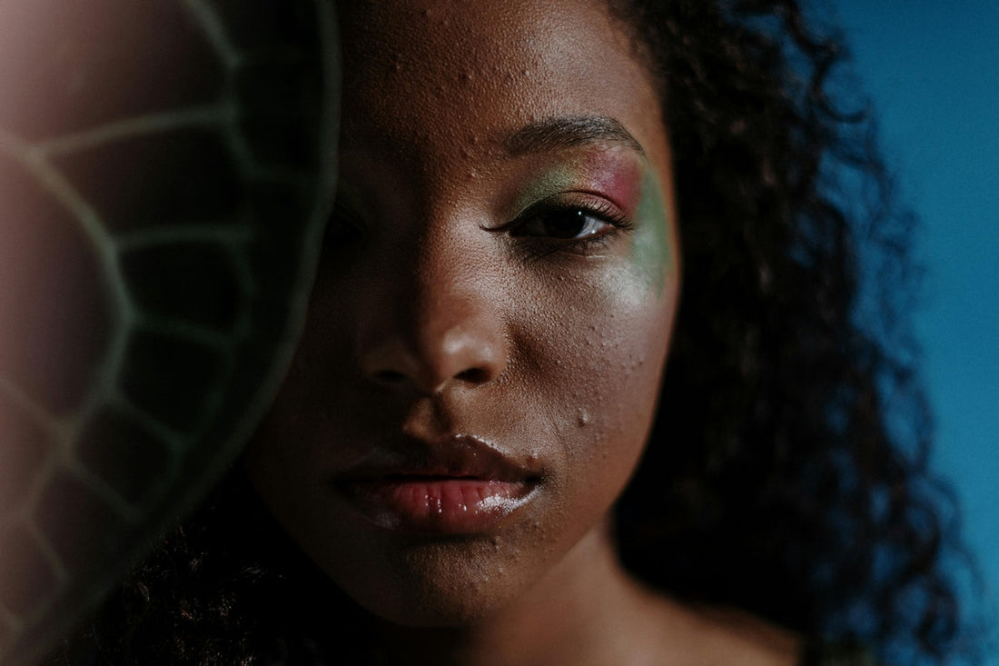 black woman with curly hair showing mild acne, related to biotin and acne treatment